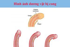 Bài tập cho cậu nhỏ bị cong