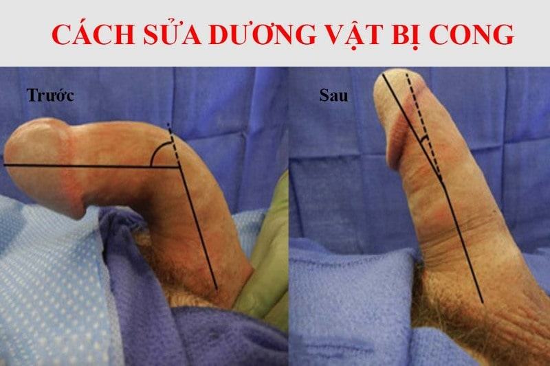 bài tập cho cậu nhỏ bị cong bài tập cho cậu nhỏ bị cong
